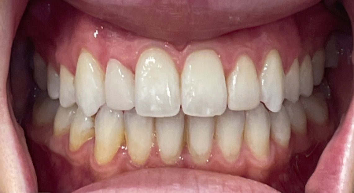 After - Londent Dental