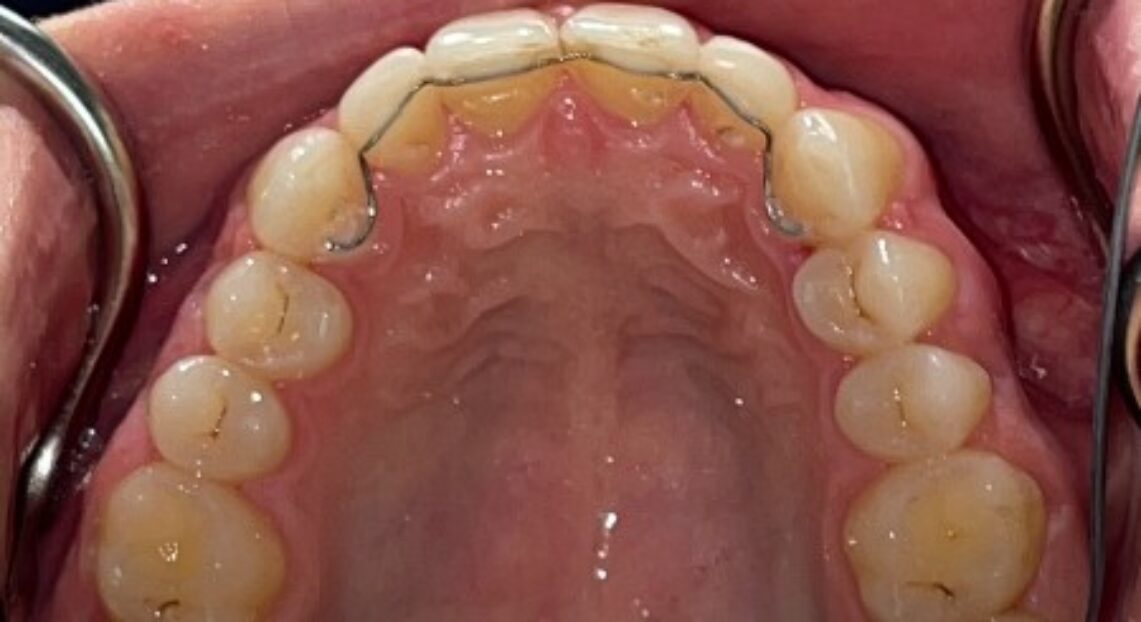 After - Londent Dental