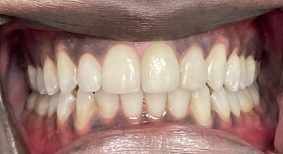 After - Londent Dental