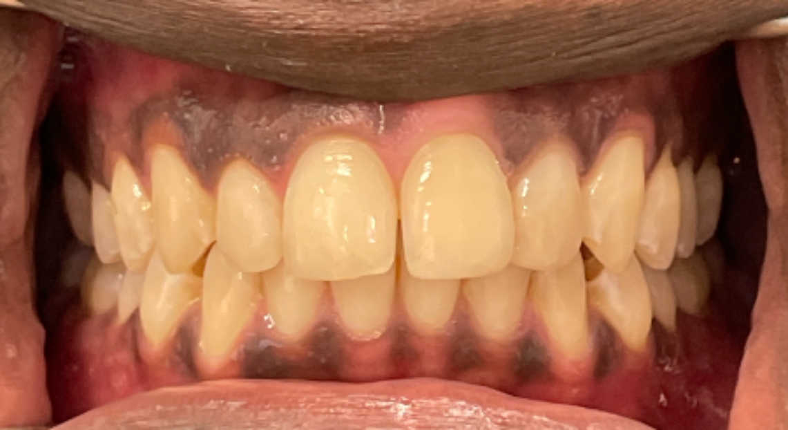 Before - Londent Dental