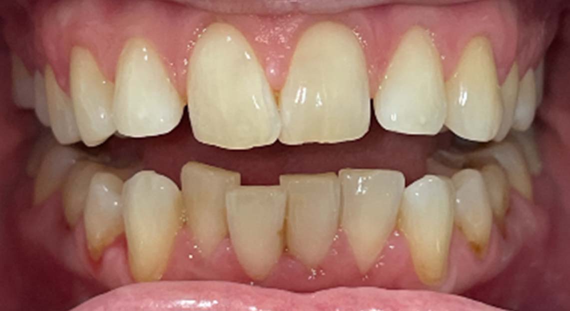 Before - Londent Dental