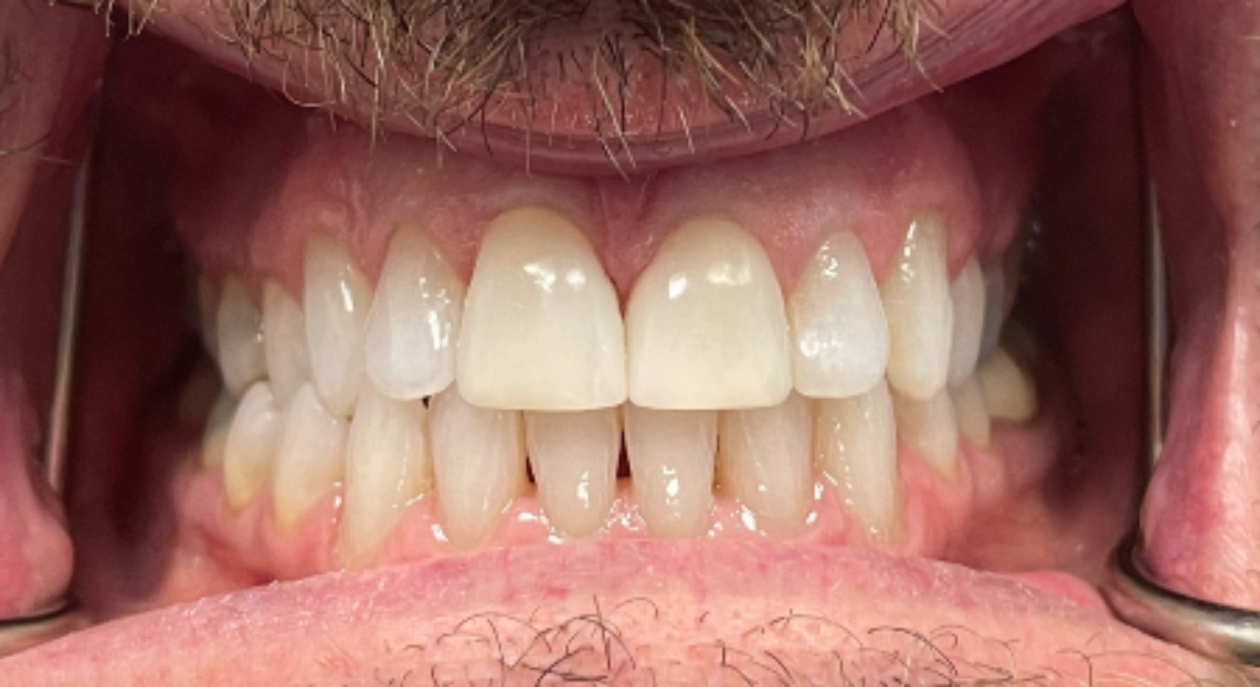 After - Londent Dental 