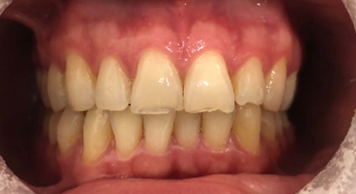 Before - Londent Dental 