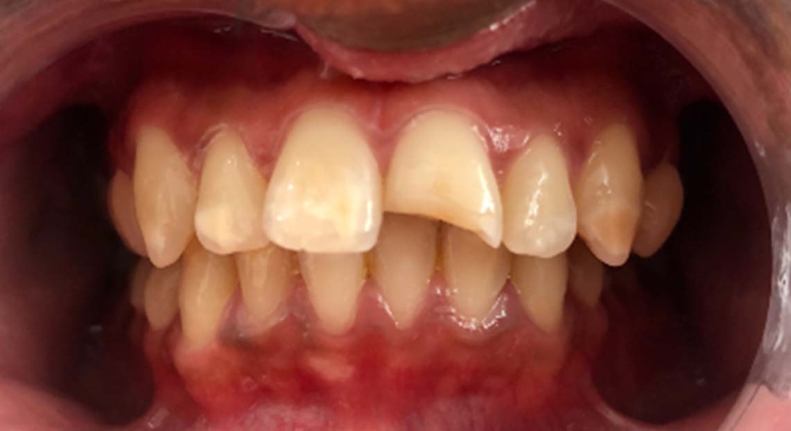 Before - Londent Dental 