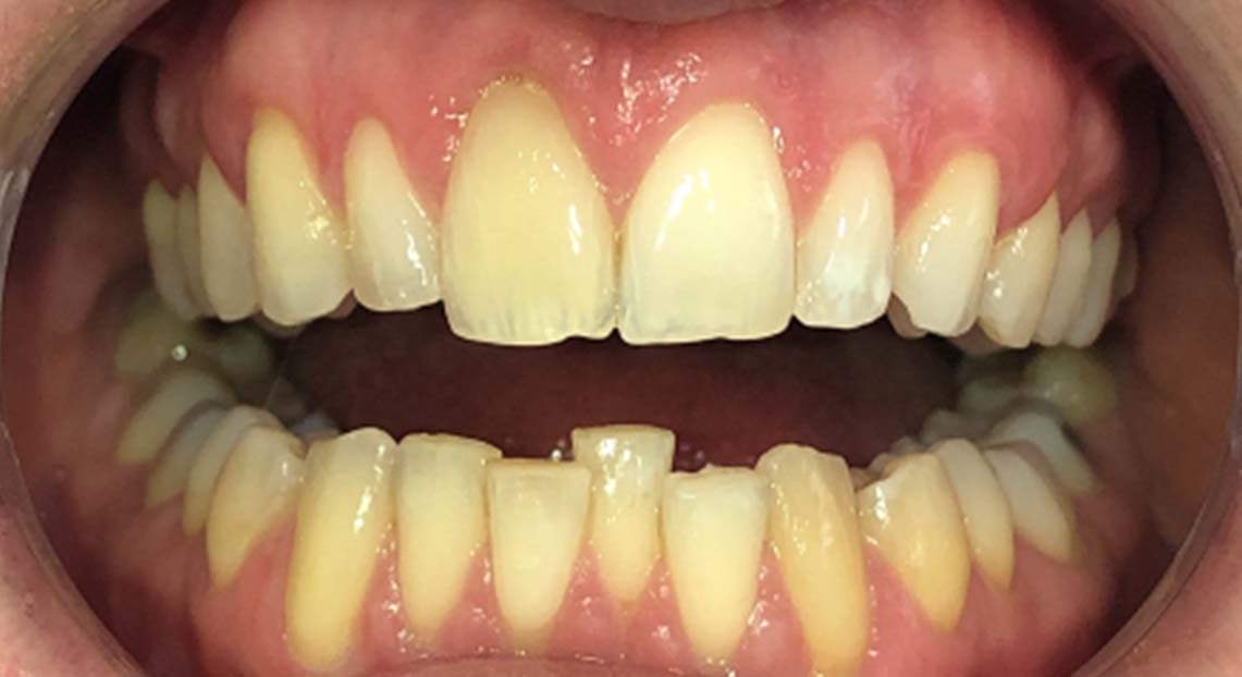 Before - Londent Dental