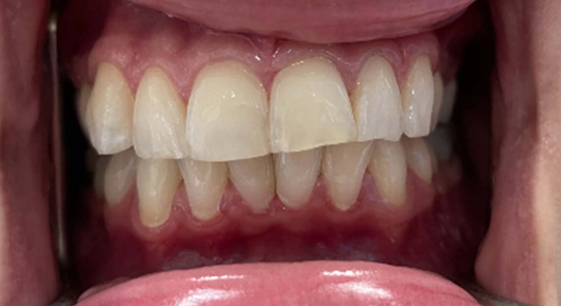 Before - Londent Dental