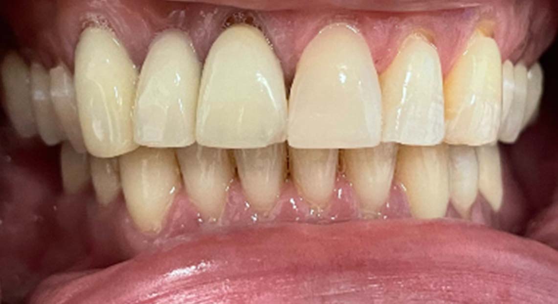 After - Londent Dental