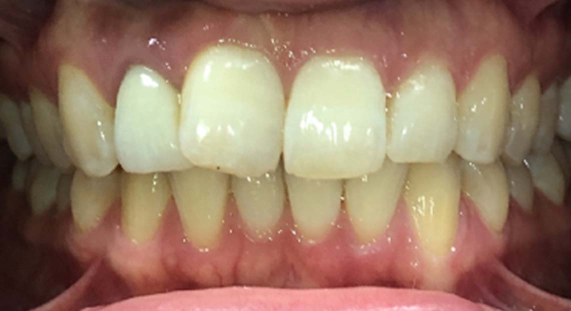 Before - Londent Dental