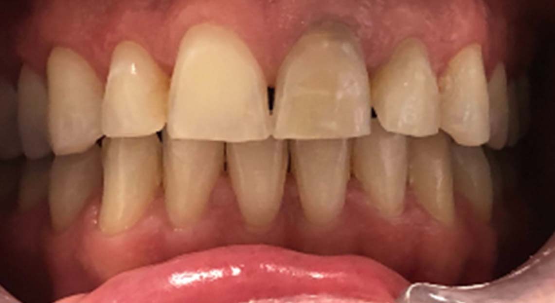 Before - Londent Dental