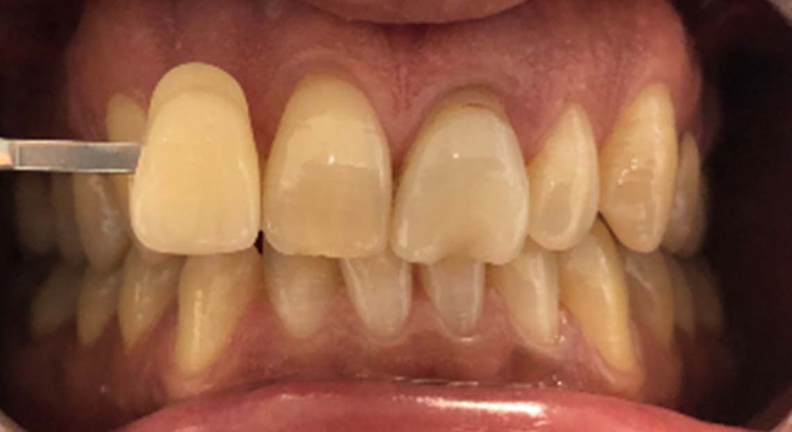 Before - Londent Dental