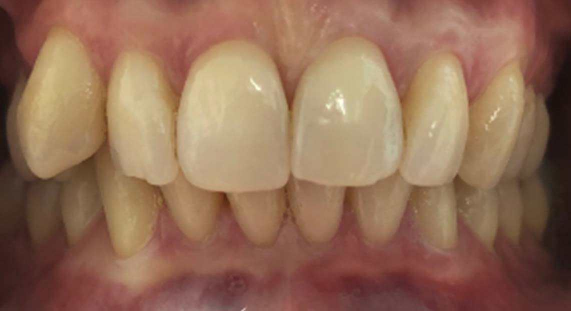 Before - Londent Dental 