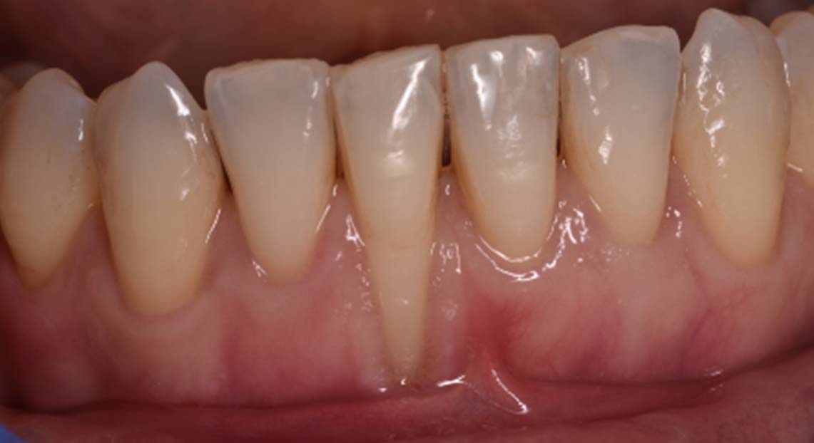 Before - Londent Dental