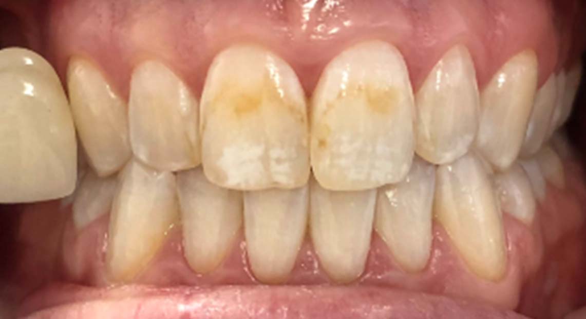 Before - Londent Dental